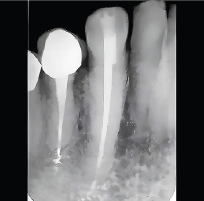 Clinical Case Study: A Next-Generation Endodontic Material